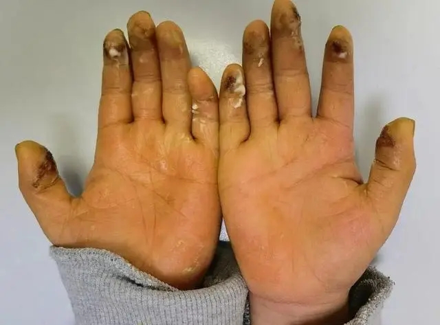 8岁小学生沉迷拍烟卡手指溃烂 被父母强制带去治疗