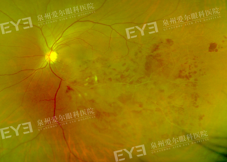 25岁小伙眼睛惊现“火焰”？医生提醒：三高人群需注意！